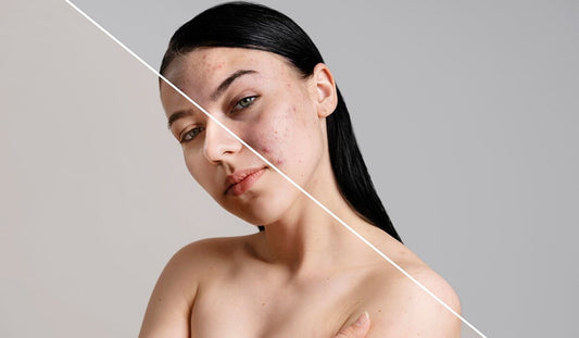 Tan vs. Pigmentation