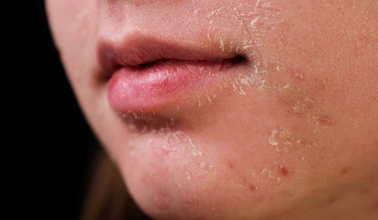 When Hydration Isn’t Enough: The Science of Why Your Skin Feels Dry - Neude Skin