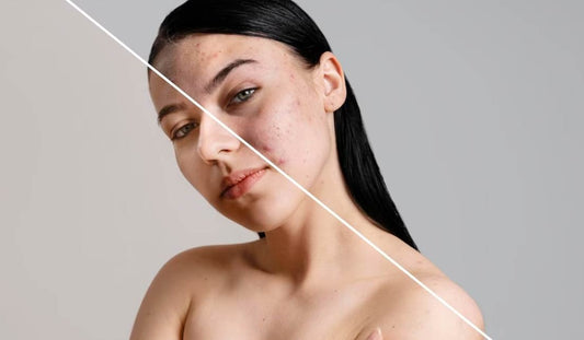 5 Ways in Which Unhealthy Skin Barrier Affects Your Skin Texture - Neude Skin