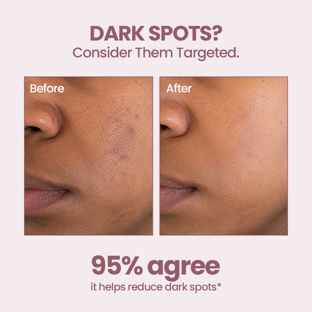 SkinGenesis Super Serum with Niacinamide+Lactic Acid+Hyaluronic Acid