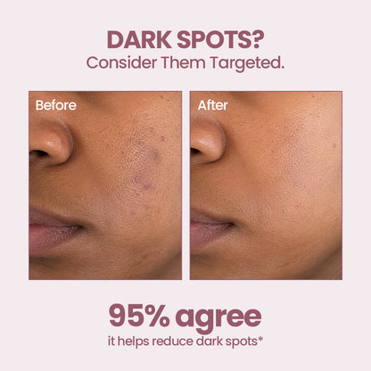 SkinGenesis Super Serum with Niacinamide+Lactic Acid+Hyaluronic Acid